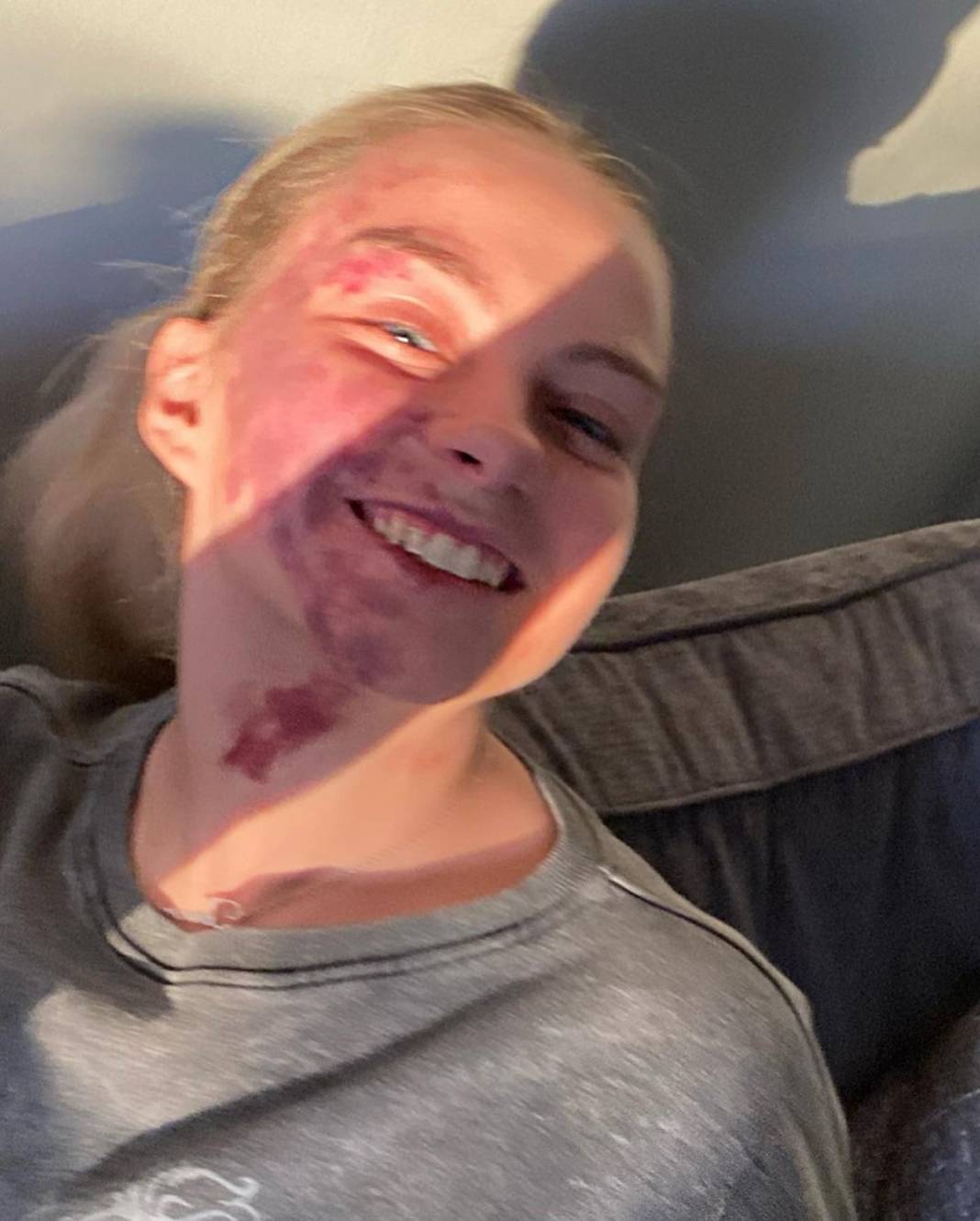 Basit bir uçuk zannetti, korkunç hastalığa yakalandı! Doktorlar bile teşhis koyamadı 5